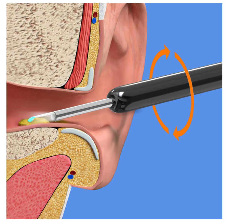 earwax removal kit